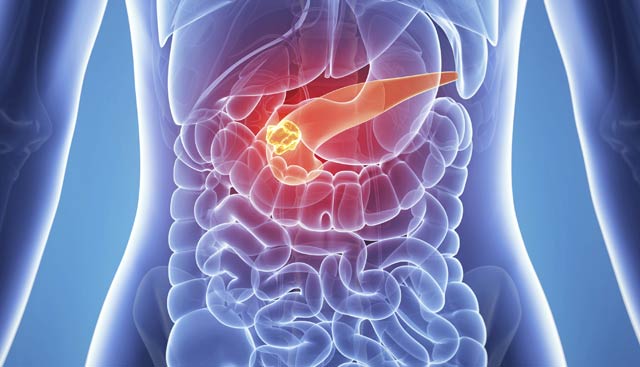 The final days of pancreatic cancer
